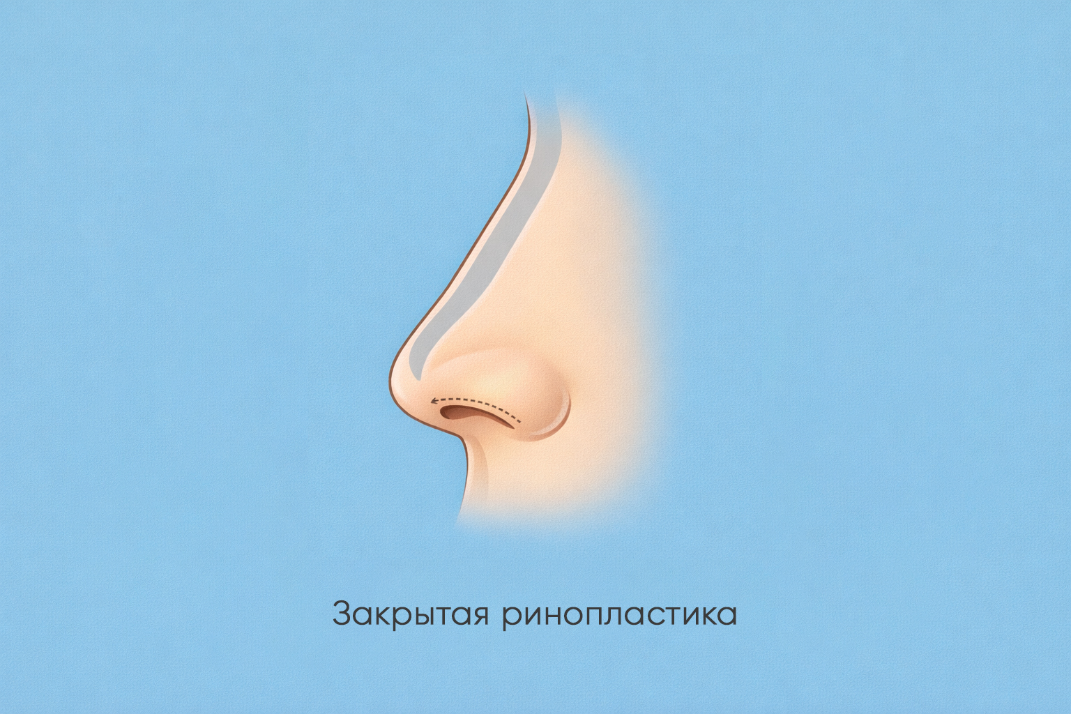 Ринопластика