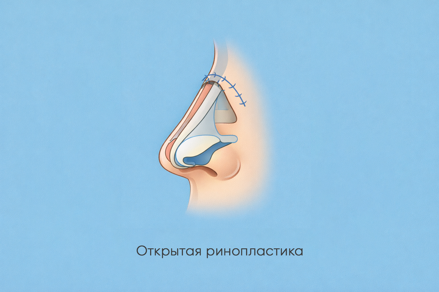 Ринопластика
