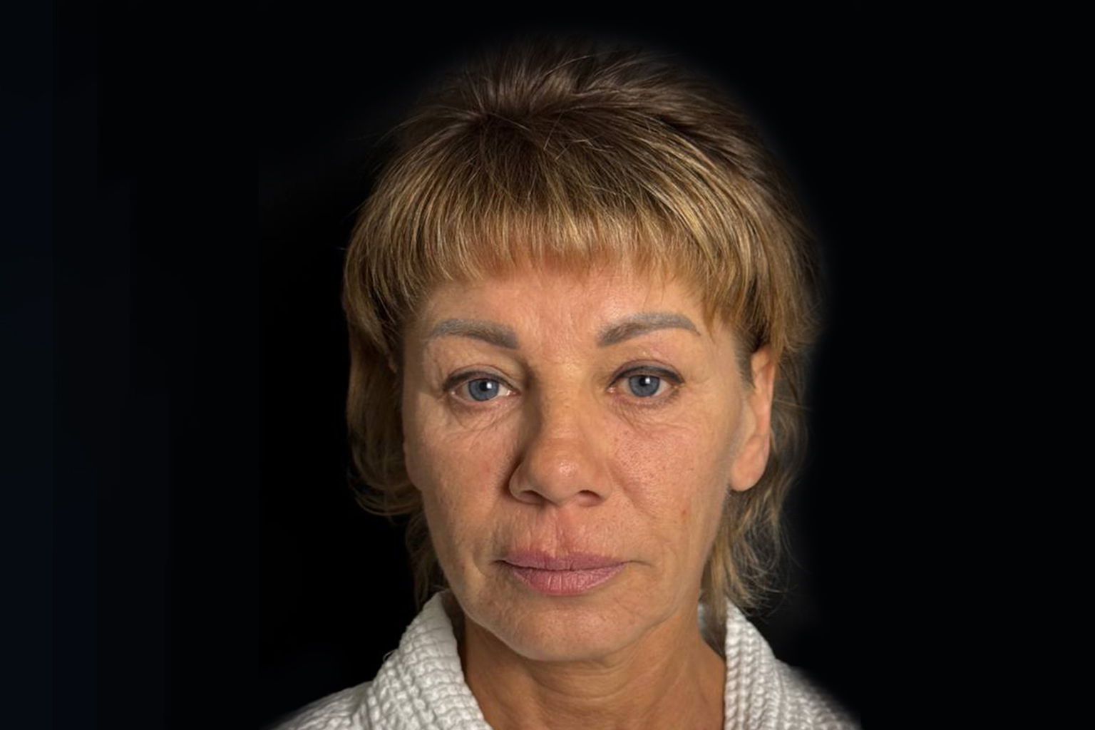 Классический лифтинг лица