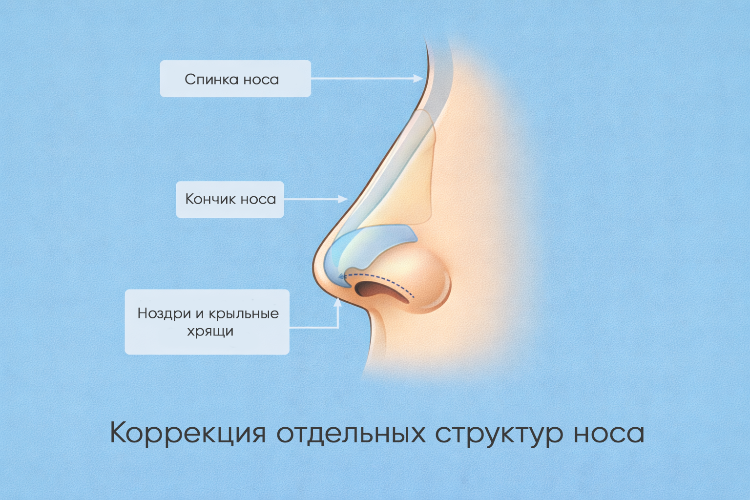 Ринопластика